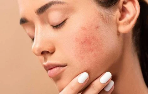 بهترین کار برای از بین بردن جای جوش