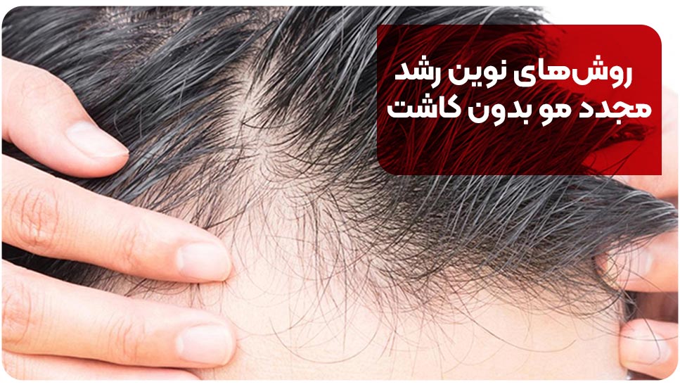 روش‌های نوین رشد مجدد مو بدون کاشت