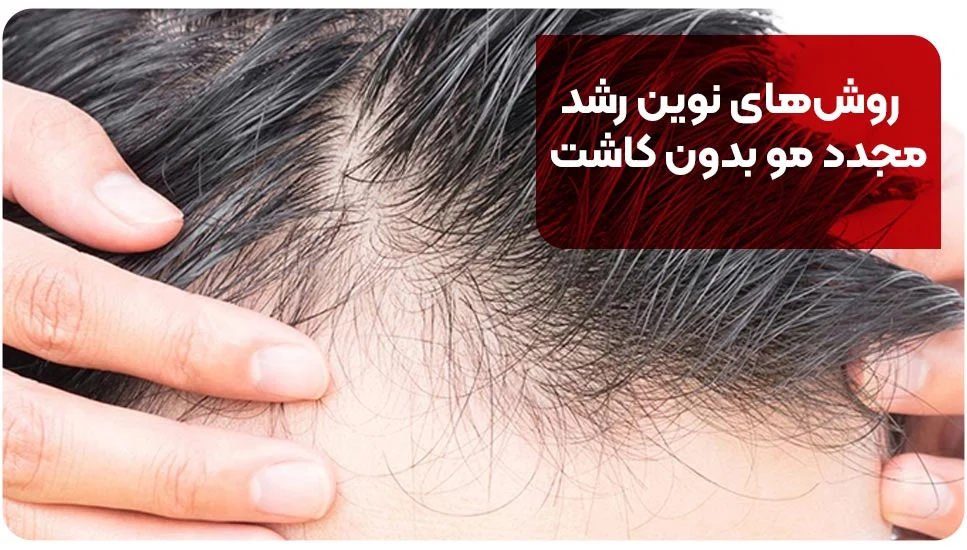 پوست روشهای نوین رشد مجدد مو بدون کاشت