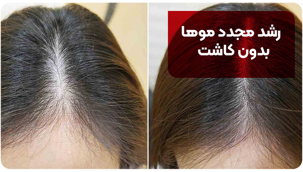 رشد مجدد موها بدون کاشت