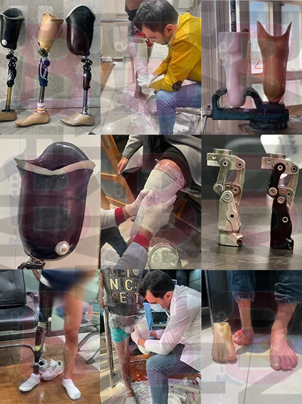 بهترین پروتز پا